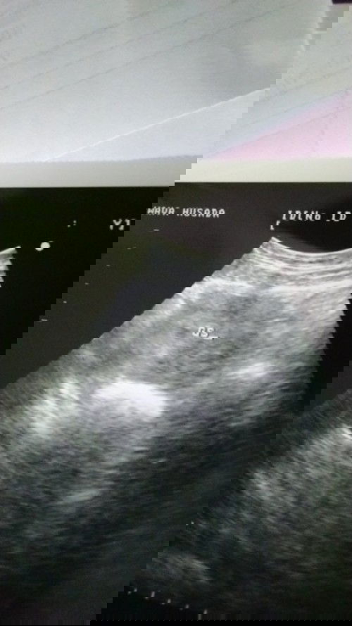 USG Kehamilan 5 weeks awal