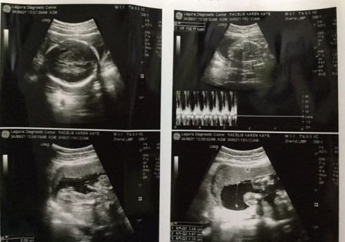 Baby Girl at 25 weeks
