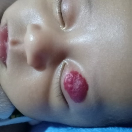 Hemangioma please heal my baby Lord 😭😭😭😭😭🙏🙏🙏🙏🙏💙💙💙💙