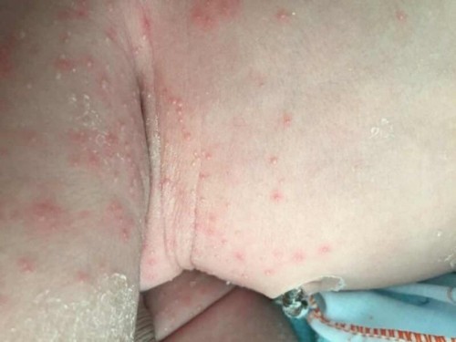 ครีมรักษา น้องพึ่งได้8วัน