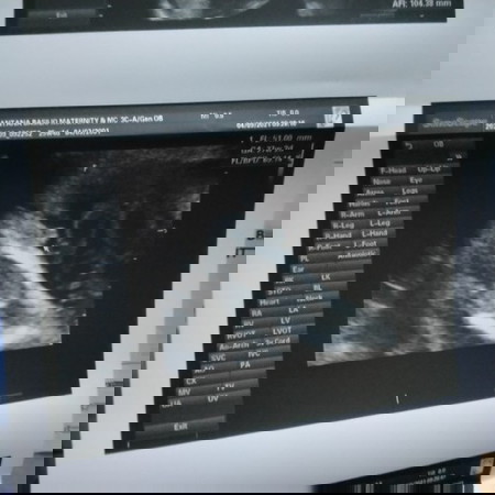 ask ko lang po if girl ba talaga result ko comment po sa ganto rin kuha ng ultrasound and tama po