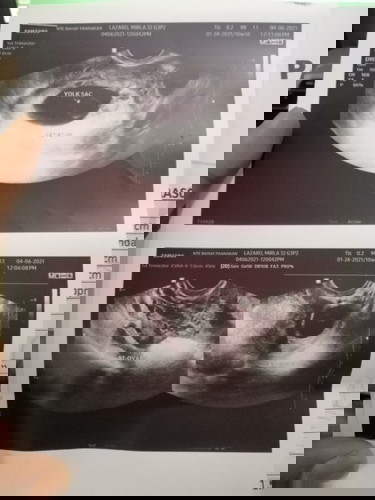 8 weeks pero yolk sac palang may chance pa naman siguro diba? Sino may experience please help