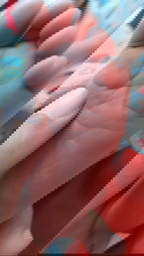 Melahirkan dengan Pre Eklampsia