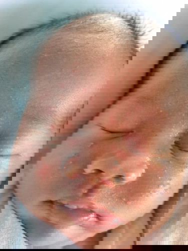 Normal lng po ba ung rashes sa mukha ng baby. 24 days plang po sya. Thankyou