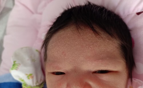 เด็กแรกเกิด 7วัน เป็นผด