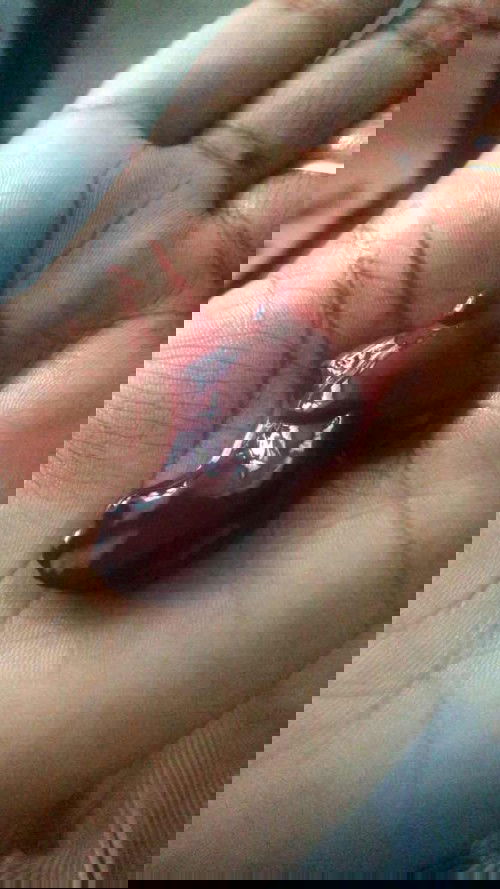 Pendarahan yang banyak