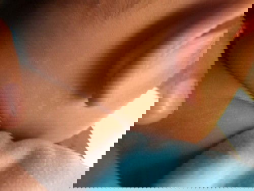 Bercak putih pada kulit bayi usia 5bulan