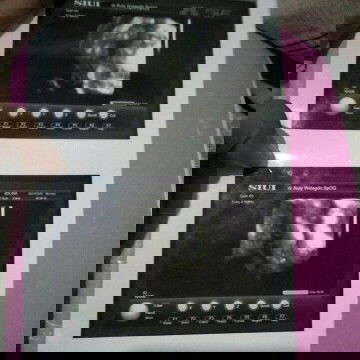 Keakuratan Hasil usg