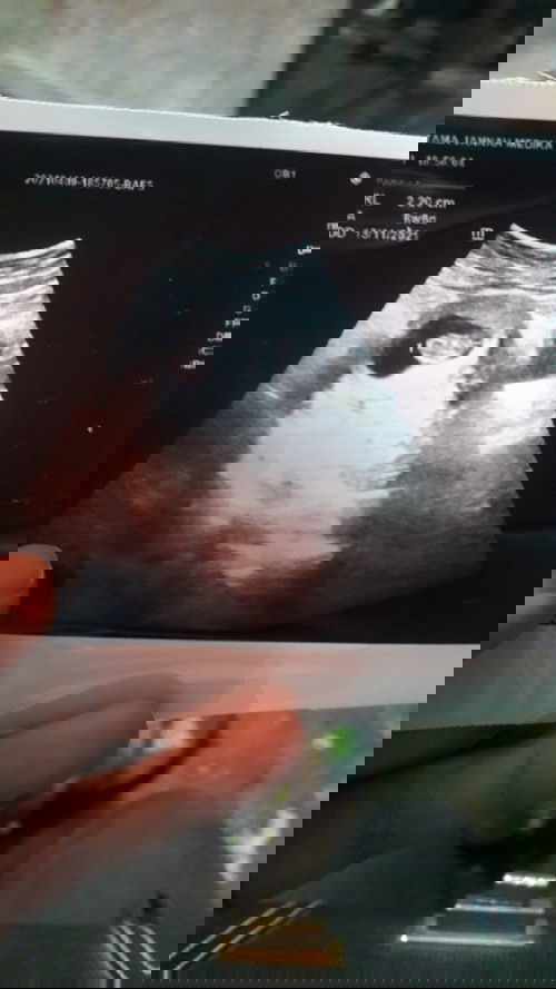 Janin sehat walaupun ngeflek