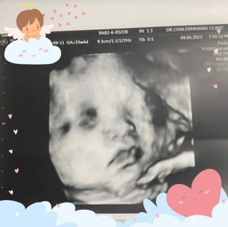 น้องเฌอแตม 33 w 4 วัน ❤️ นน 2240g แล้ว ค่ะ แม่ๆทีมพฤษภา ถึงไหนกันบ้างแล้วคะ
คุณหมอ บอก ตัวแก้มใหญ่ ตัวใหญ่มากกก😊 กำหนดผ่า 13 พฤษภาคม ค่ะ