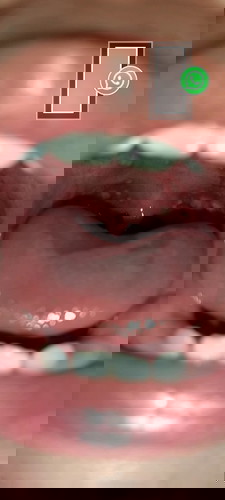 Anak saya flu singapur