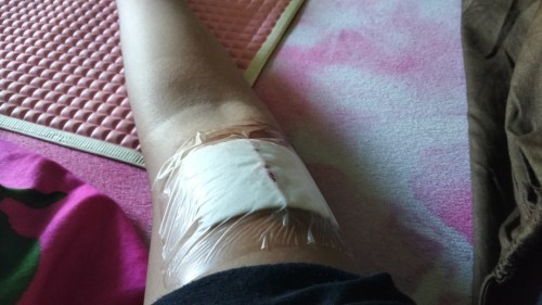 Kb implan atau susuk