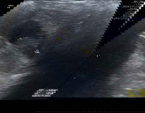 Kantong janin lonjong