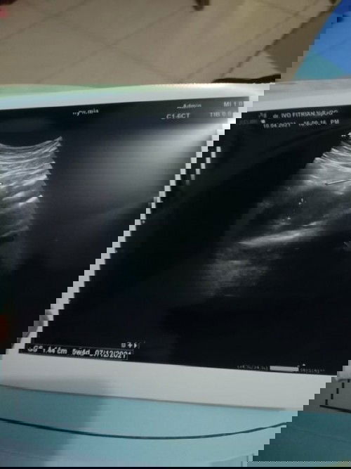 Bingung melihat hasil usg