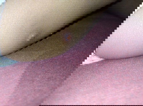 Bekas luka yg menonjol pada anak