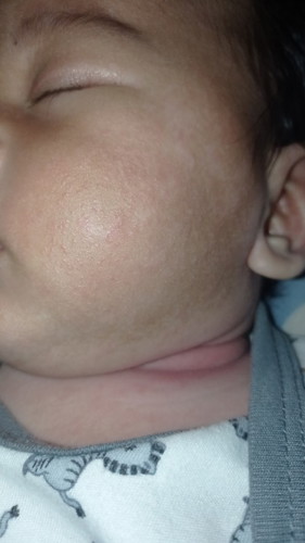 Kulit bayi 2 bulan 23 hari tidak merata