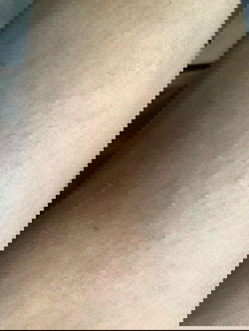 ตุ่มผื่นคันอันตรายมั้ย