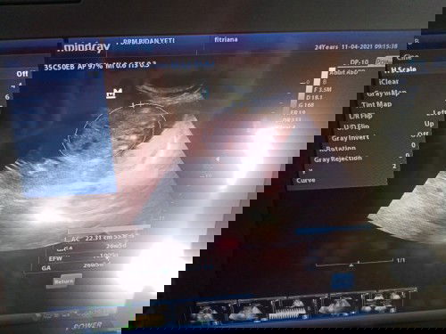 Bun td q usg bbj 1009g pdhl msh 26w sdngkn d aplksi 760g kta bidn nrml sh tp q tkt kgdean gmna bun ?