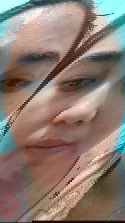 Cacar air (bengkak merahdan melepuh)