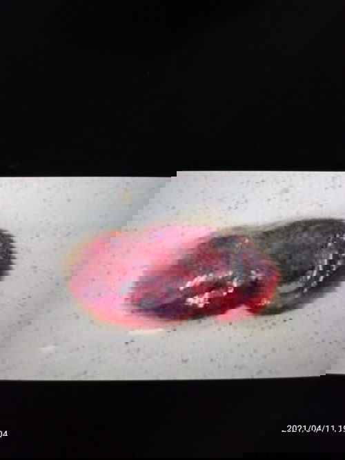 Gumpalan darah seperti keguguran