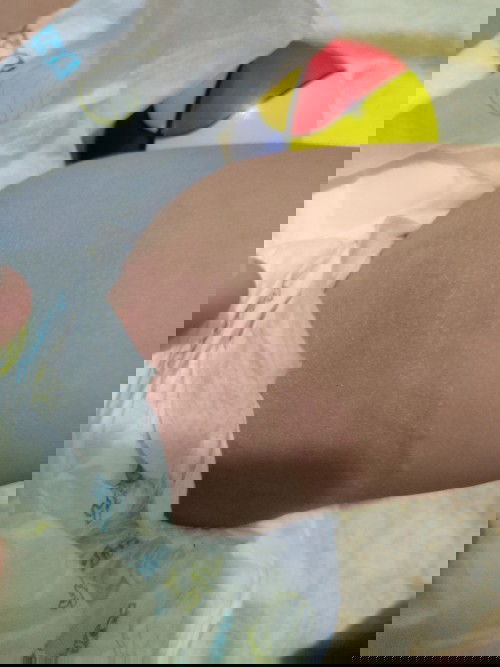 Diaper rash