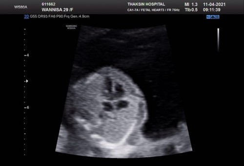 เจาะน้ำคร่ำ มีผลเสียมั้ยค่ะ ผลอัตราซาวด์ หัวใจเด็ก มีเนื้อออกมานิดนึง หมอให้เจาะเพื่อหาความผิดปกติ. คุณแม่อายุ 29 ปี อายุครรภ์ 16 สัปดาห์