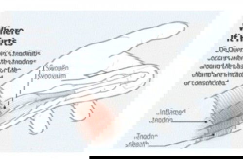 Tendinitis/Peradangan Tendon