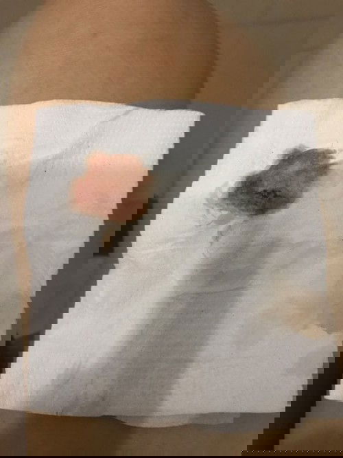 เลือดออกเป็นสีน้ำตาลขณะตั้งครรภ์