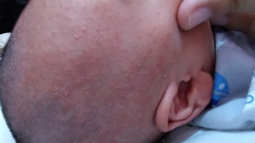 Bintik Merah di bayi baru lahir usia 12 hari