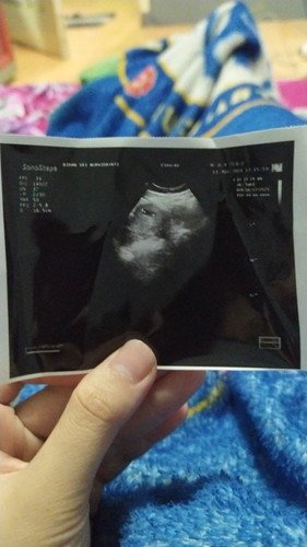 USG 9 minggu belum ada janin nya