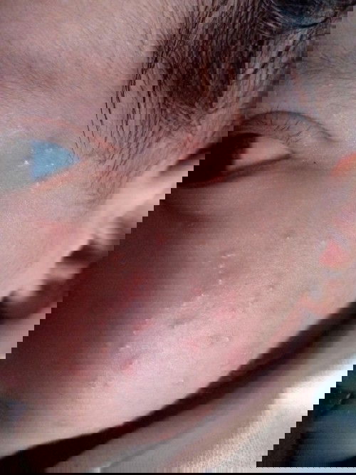 Good day, ano po kaya remedy nito. Umabot na kasi sa leeg ni baby. Makati po ba ito? Thank you.