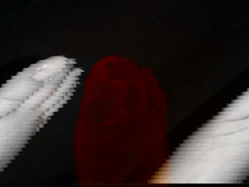 Jempol kaki bengkak (Cantengan)