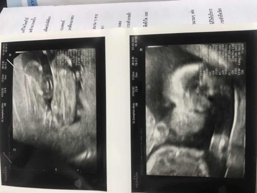 20week ตั้ง
ครรภ์