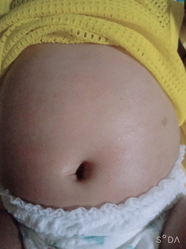 ลูกเป็นผื่นที่ท้องเกิดจากอะไร??
