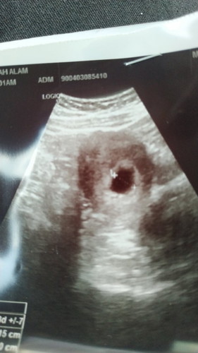 Dah 10 minggu pergi scan doctor tunjuk kantung je, normal ke?