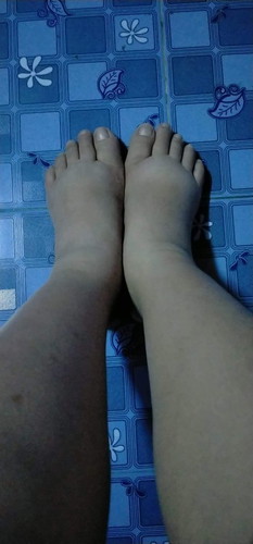 เท้าบวมมากปกติไหมคะ