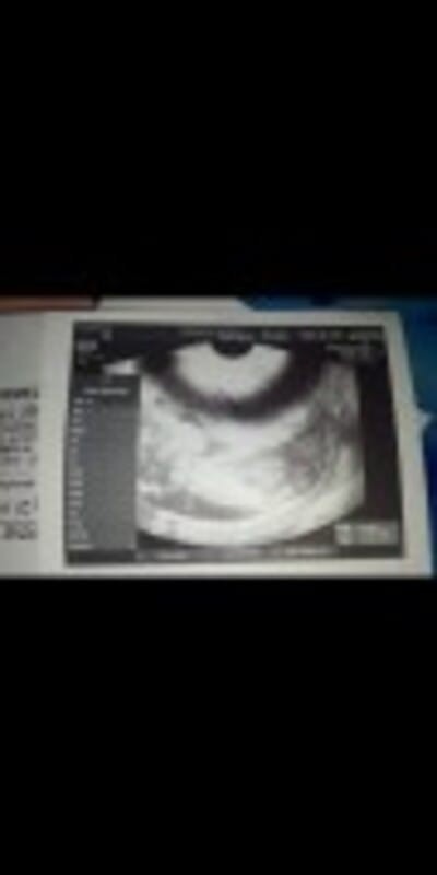 1st ultrasound