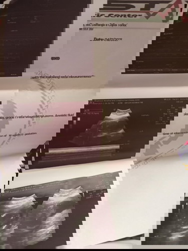 Nagpa ultrasound po ako 20 weeks and 5 days dipo makita gender ni baby nakadapa daw po sya..........