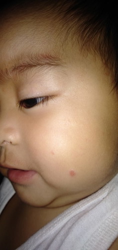 Kagat ng lamok