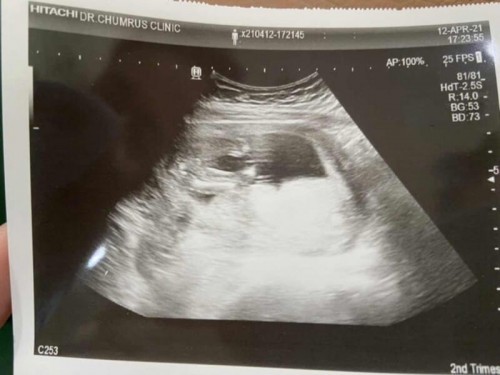 ซาวด์เพศ 16w+6d