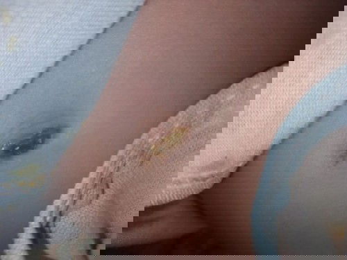 Bekas Tali pusat Belum kering