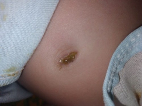 Bekas Tali pusat Belum kering