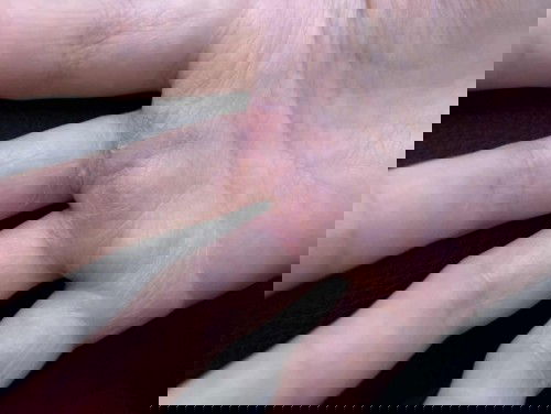 Tangan gatal2 dan merah