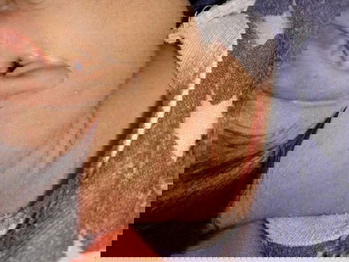 Beruntusan dileher banyak banget