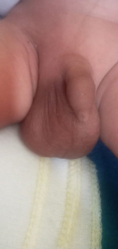 Malaki ang testacles ni baby