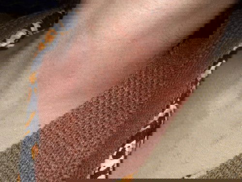 Gatal² parah saat hamil