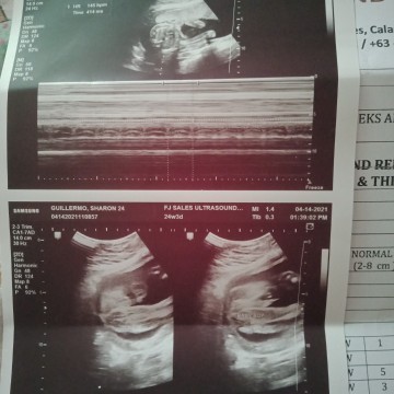 GENDER ULTRASOUND