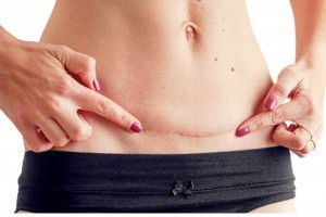 Beraktivitas setelah / pasca SC ( sesar / Caesar )