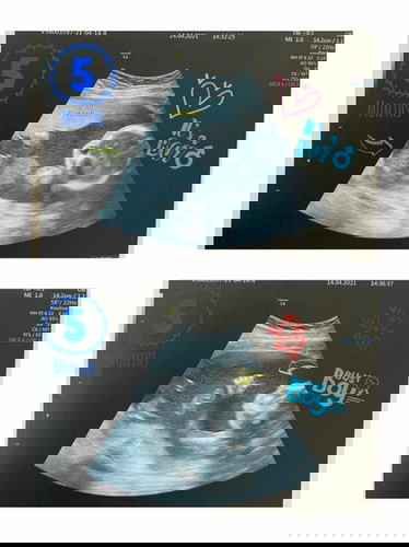 ลุ้นเพศลูกวันนี้🤍