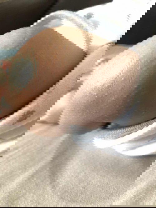 Biang keringat pada bayi